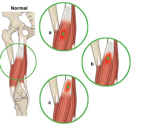 what test shows muscle tears|muscle strain vs muscle tear.